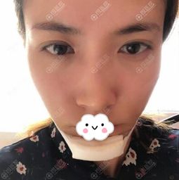 森碟下巴后缩改善了很多